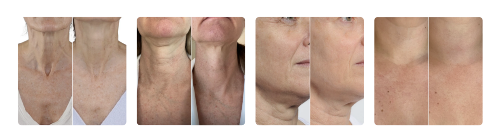Results of the Nicra pro laser on the chest and neck area